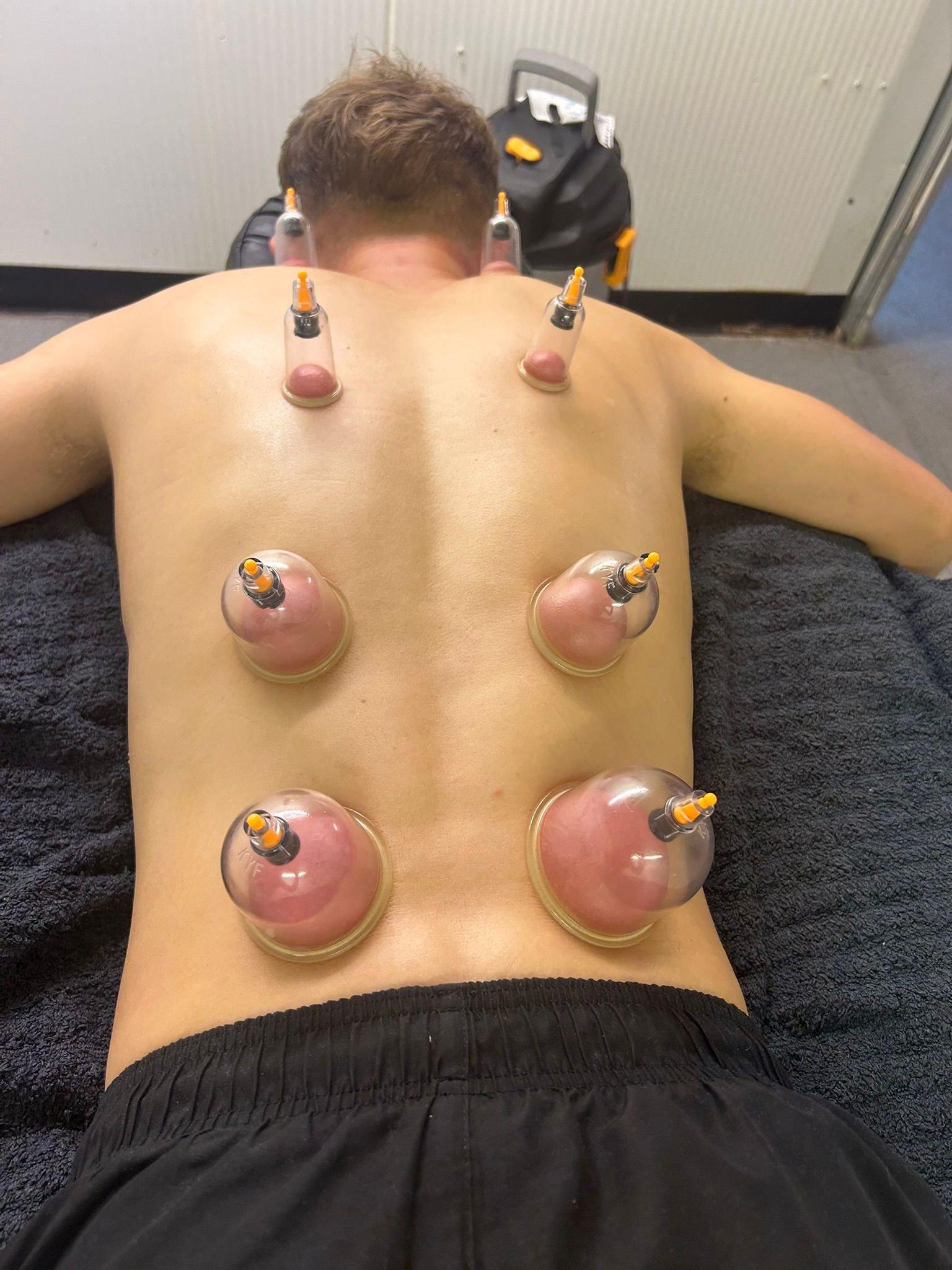 Professional cupping therapy session showing therapeutic cups applied to athlete's back at 5 Elements Gym